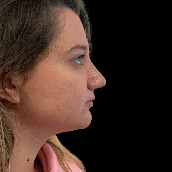 Ultrasonic-rhinoplasty-after